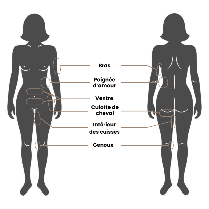 Zone de traitement cryolipolyse